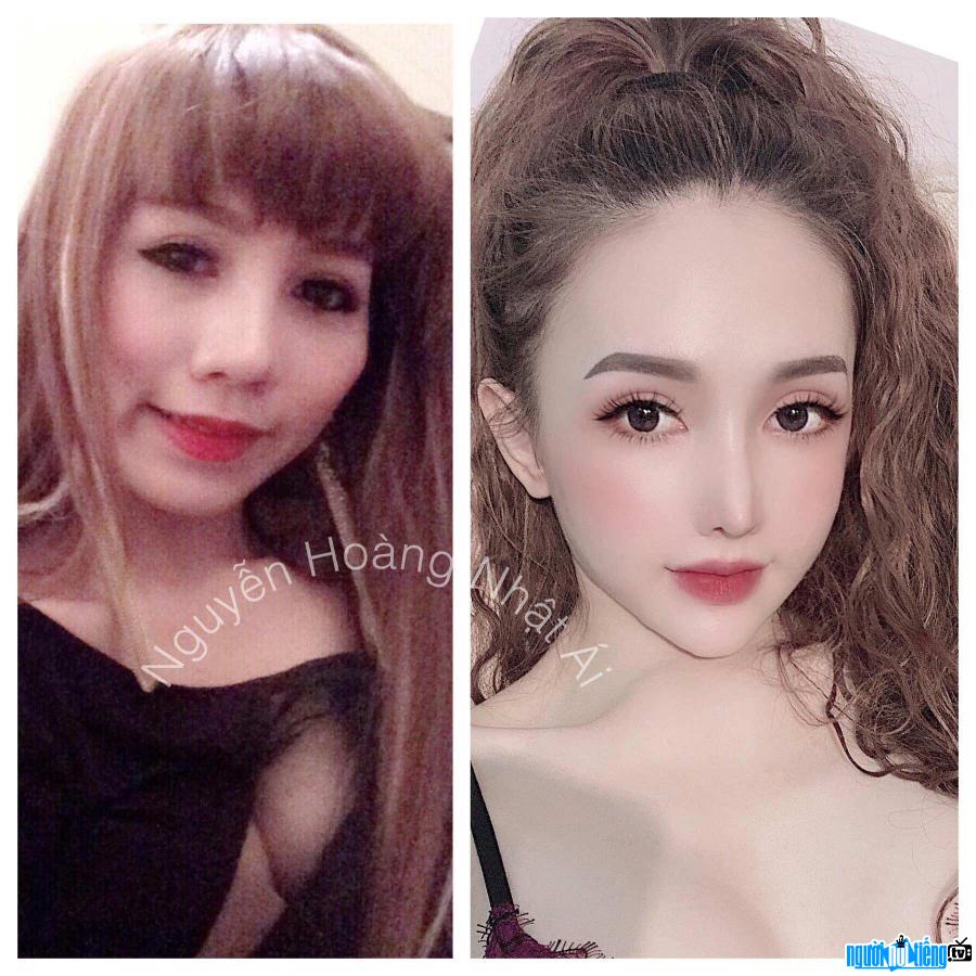  Before and after pictures of Nguyen Hoang Nhat Ai's aesthetic