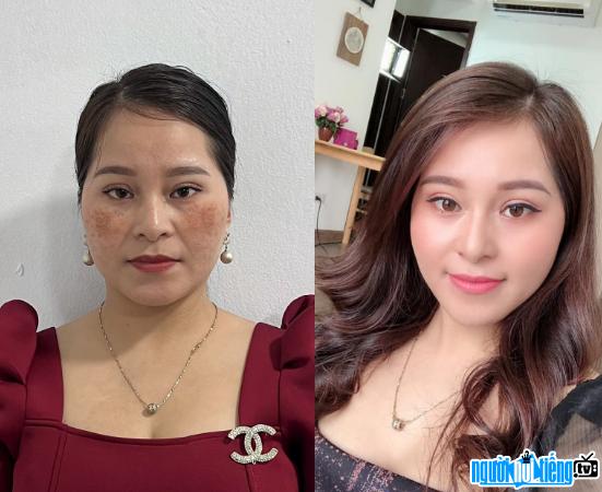  Ms. Vu Nga (Hanoi) got rid of melasma after nearly 3 months with the regimen Korean melasma treatment from expert Dam Nhu Quynh