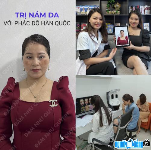  Expert Dam Nhu Quynh successfully treated melasma for female customer Van Anh