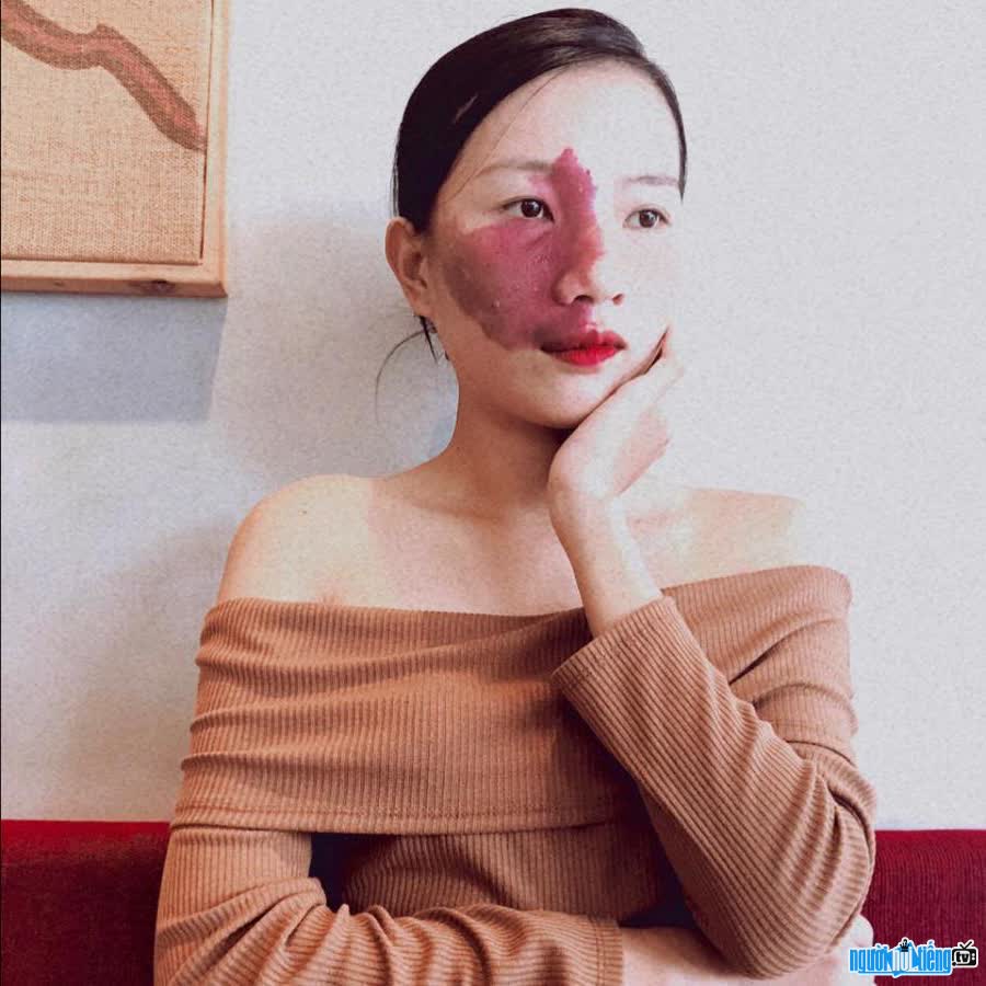 Teacher Ly Ho Bich Ngan with a red birthmark on her face